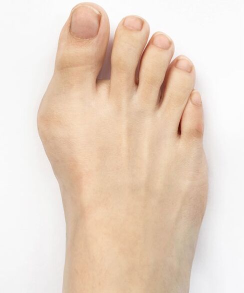 Hallux valgus antes de usar o spray Hondro Sol Valgus
