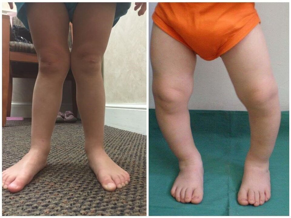 A deformación do valgus causada nos nenos