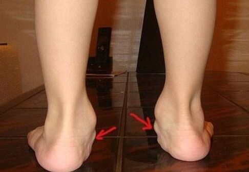 Deformación de valgus dos pés nos nenos