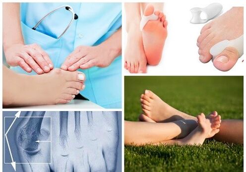 Tratamento da deformación do valgus