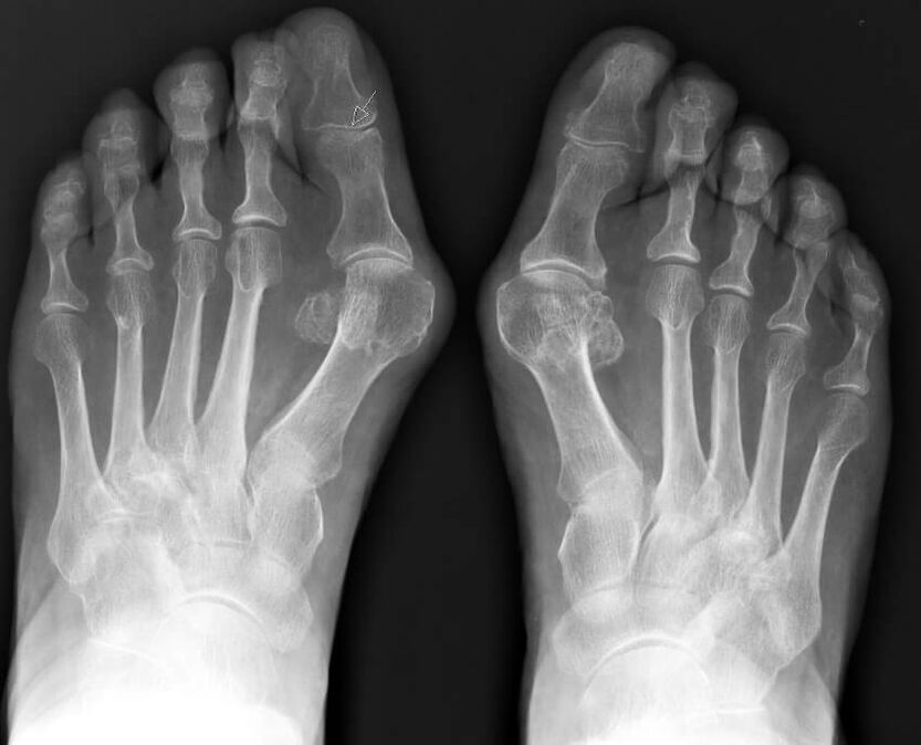 Radiografía do hallux valgus
